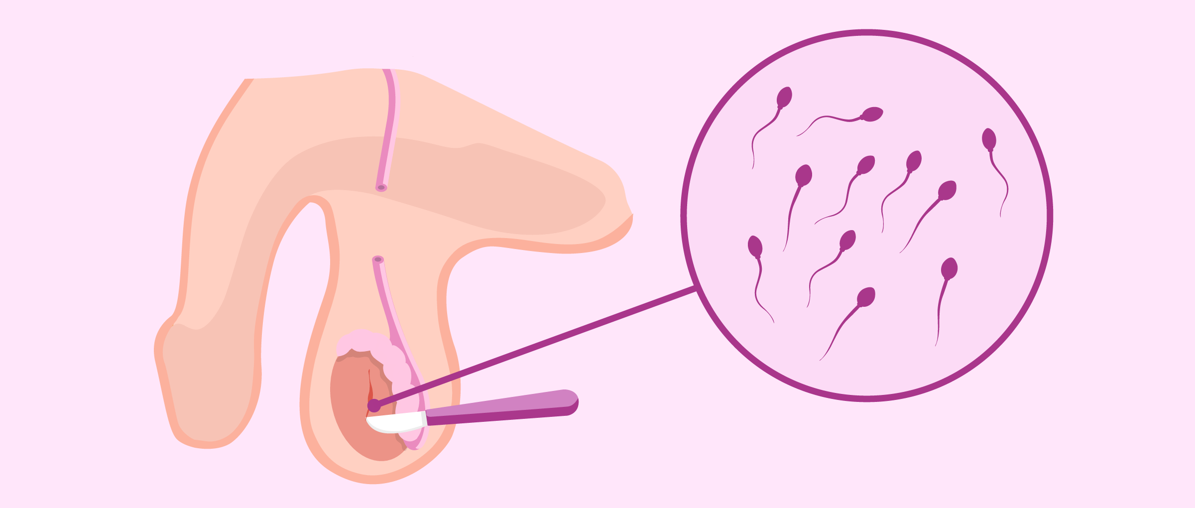 TESA PESA Treatment